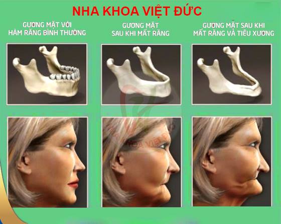  NHỮNG HẬU QUẢ KHÔN LƯỜNG CỦA VIỆC MẤT RĂNG