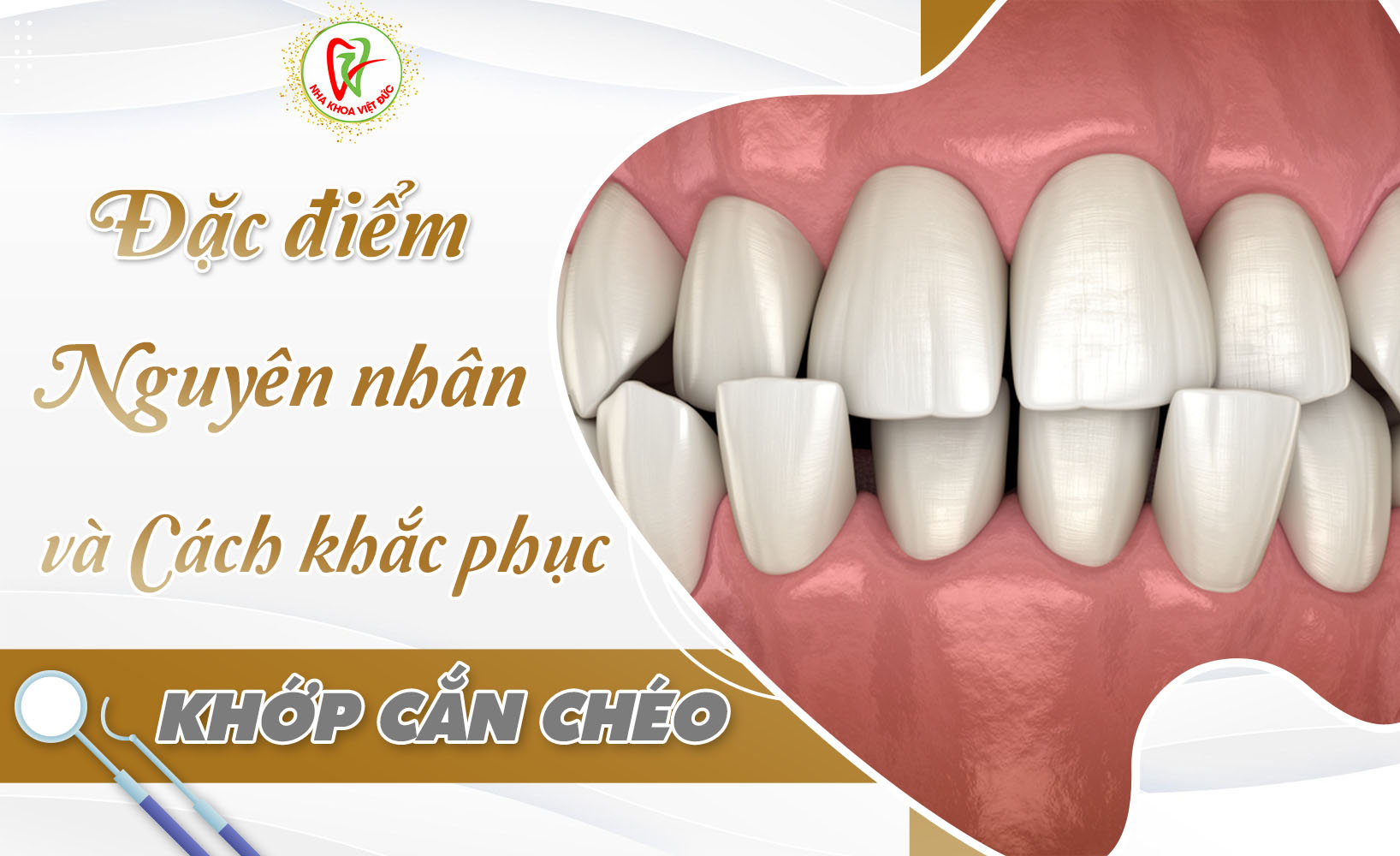 KHỚP CẮN CHÉO – ĐẶC ĐIỂM, NGUYÊN NHÂN VÀ CÁCH KHẮC PHỤC