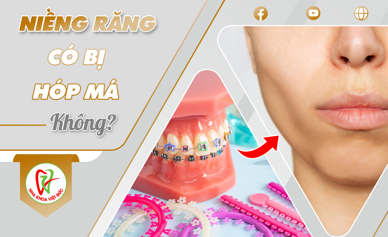 NIỀNG RĂNG CÓ BỊ HÓP MÁ KHÔNG?